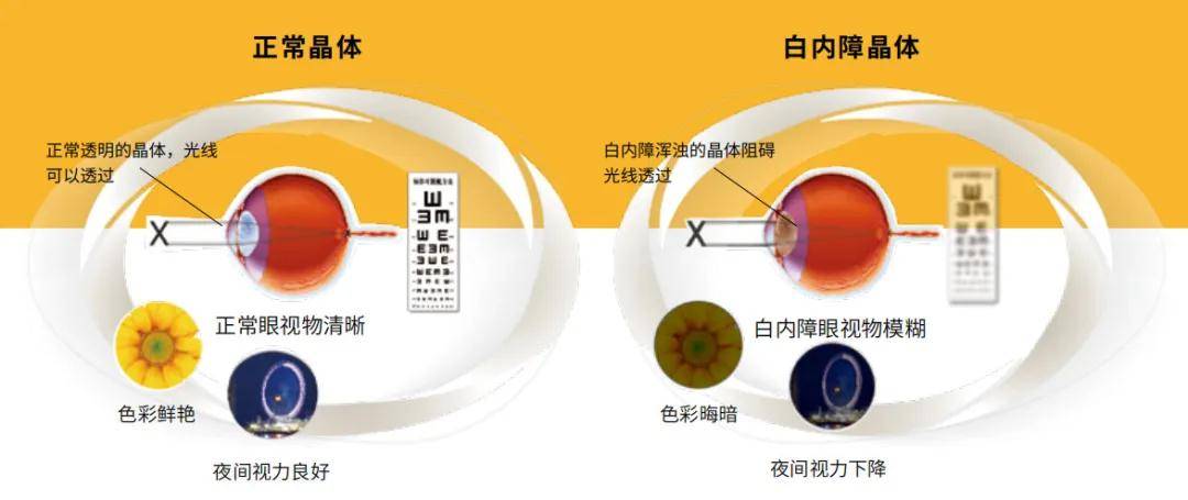 玻璃體混濁最新特效藥，突破與創(chuàng)新的治療策略